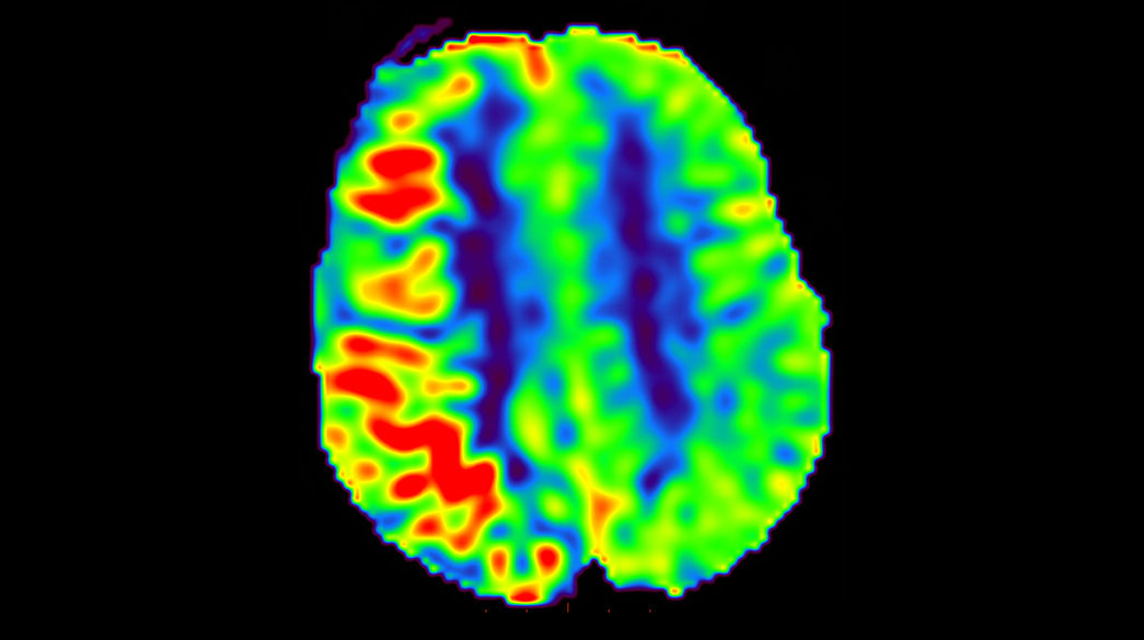 3D-Arterial-Spin-Labeling1040-x-585