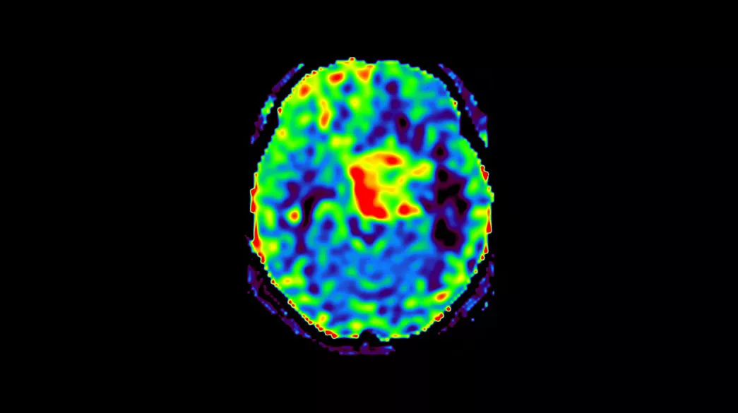 <p>3D Arterial Spin Labeling (3D ASL)</p>
