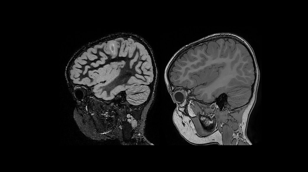 3D-Cube-3D-MP-RAGE1040-x-585