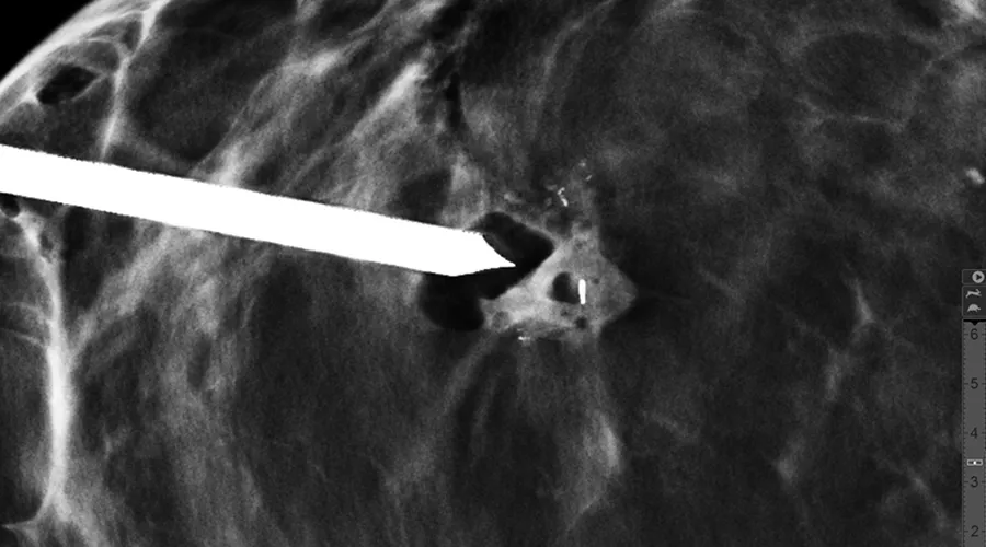 3D-post-biopsy-clip-confirmation