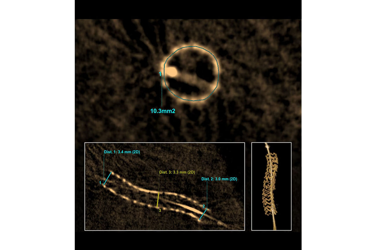 3dstent-sticky-remove-major-ci-en