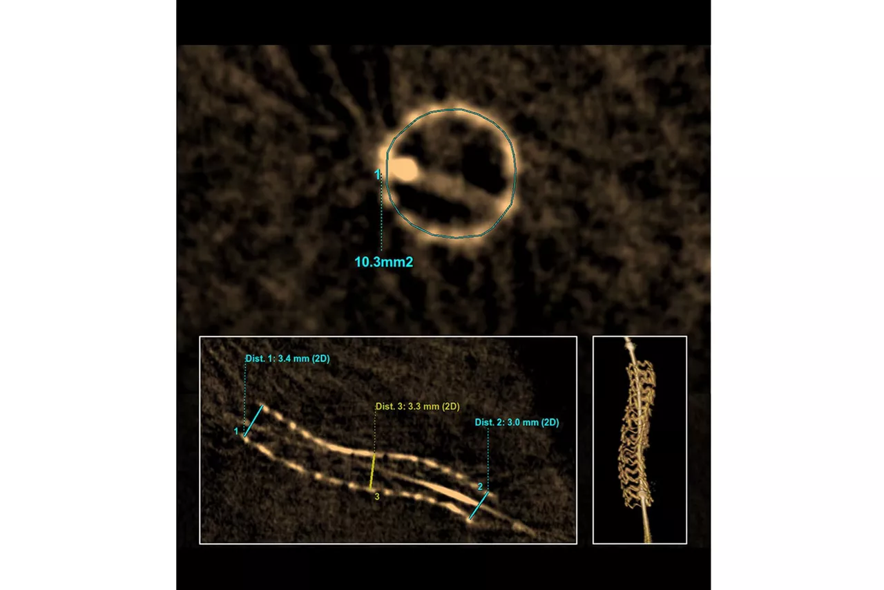 3dstent-sticky-remove-major-ci-en