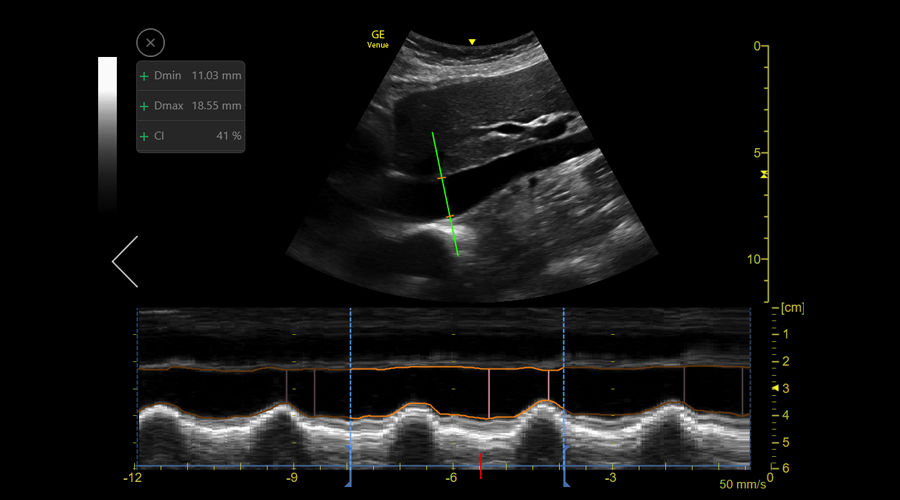Inferior vena cava (IVC) collapsibility measurements using the auto IVC tool on the Venue ultrasound system