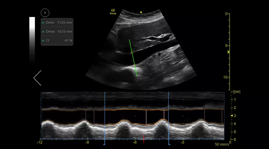 Inferior vena cava (IVC) collapsibility measurements using the auto IVC tool on the Venue ultrasound system