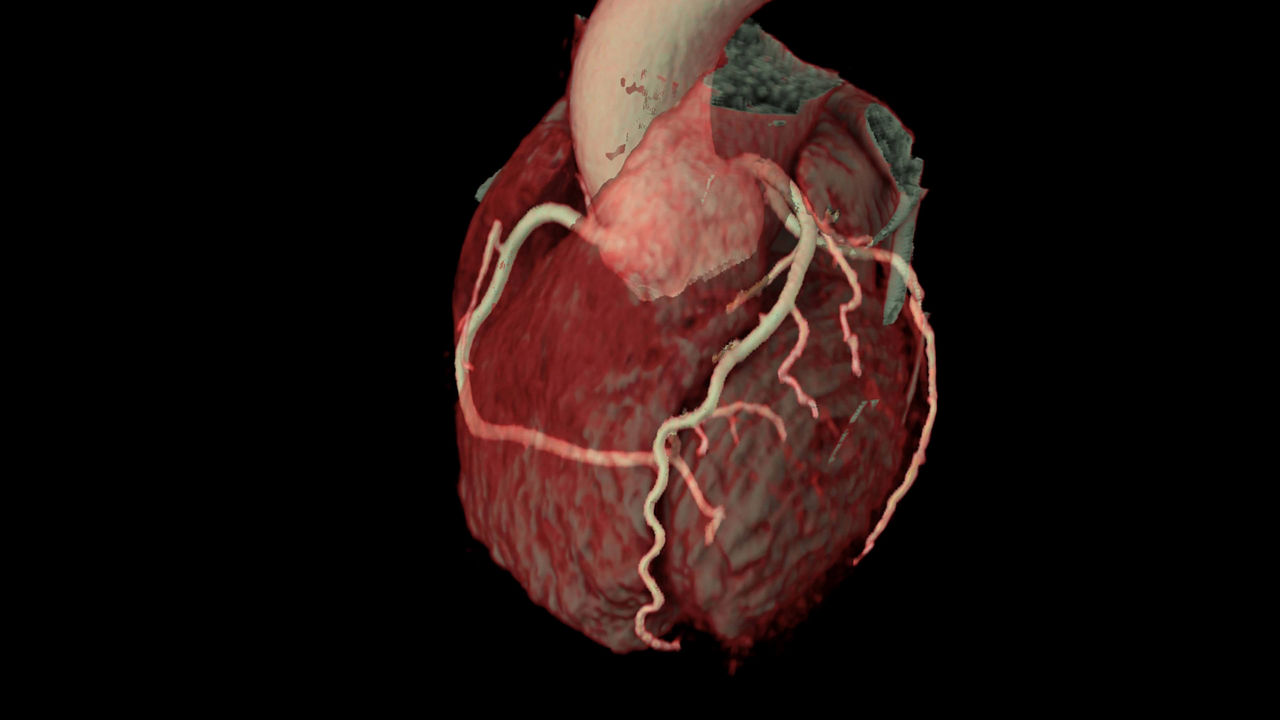 4-ecg-less-cardiac-ct-coronary-visualization