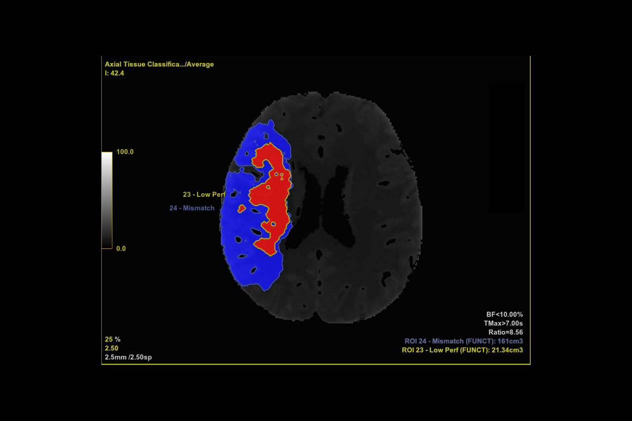 4-perfusion-maps-desktop