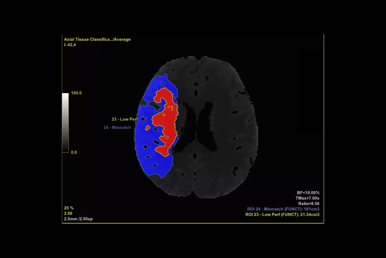 4-perfusion-maps-desktop