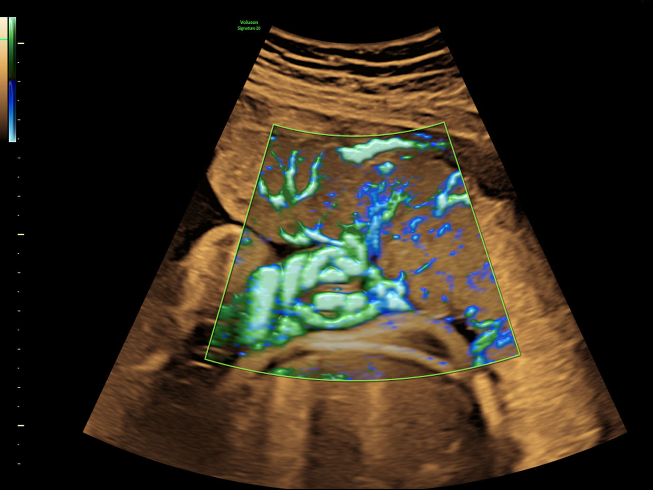 4-slowflowhd-clinical-image
