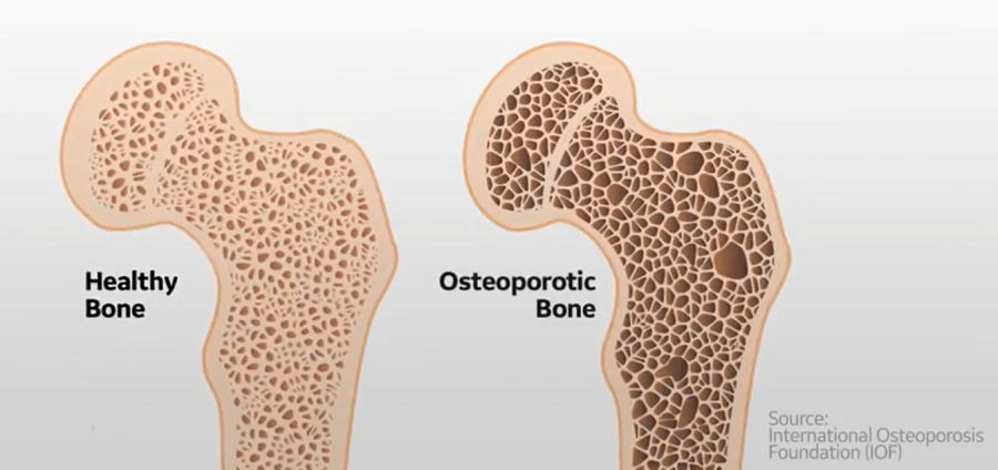 4BoneDensityTestandBodyComposition