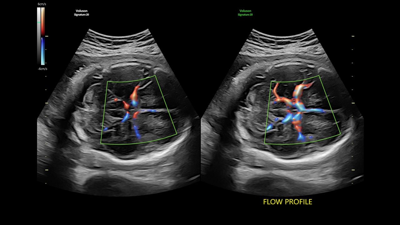 5-flow-profiles