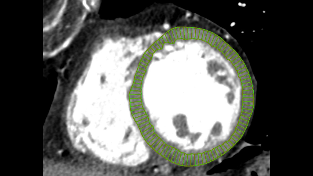5-left-ventricle-st-en