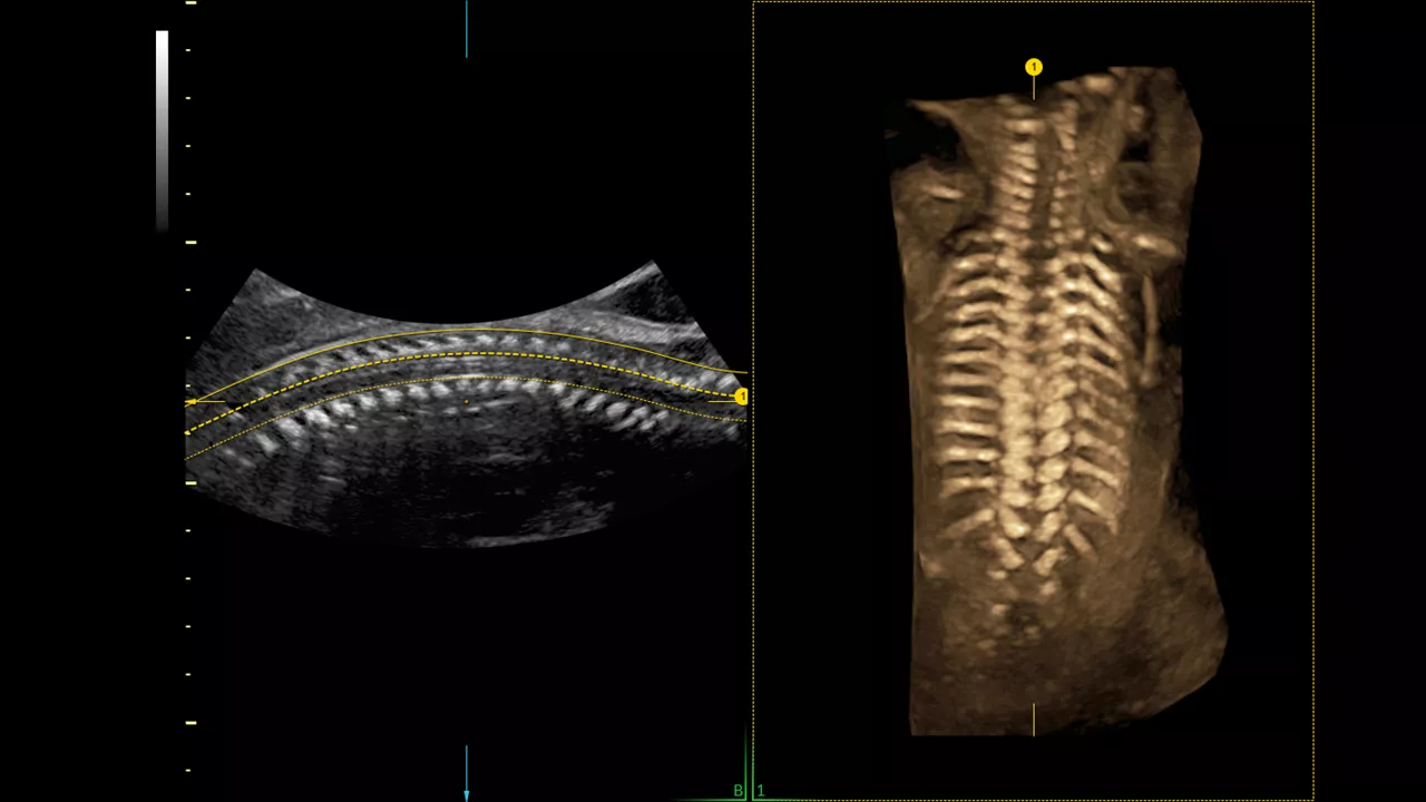 5-Spine-trace