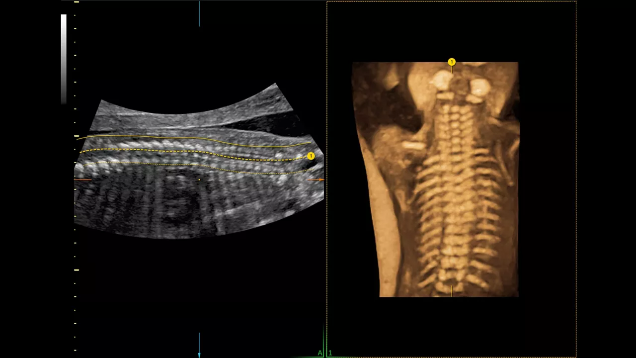6-spine-trace