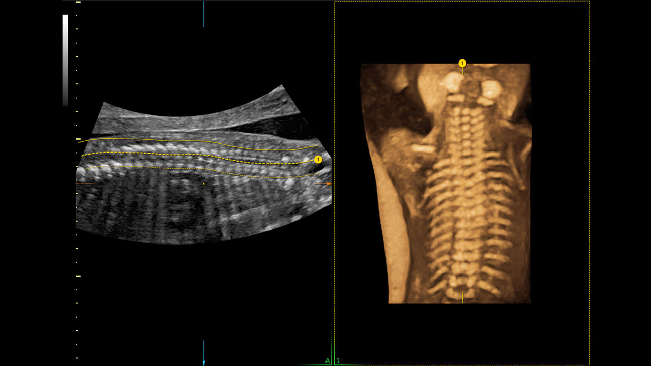 6-spine-trace