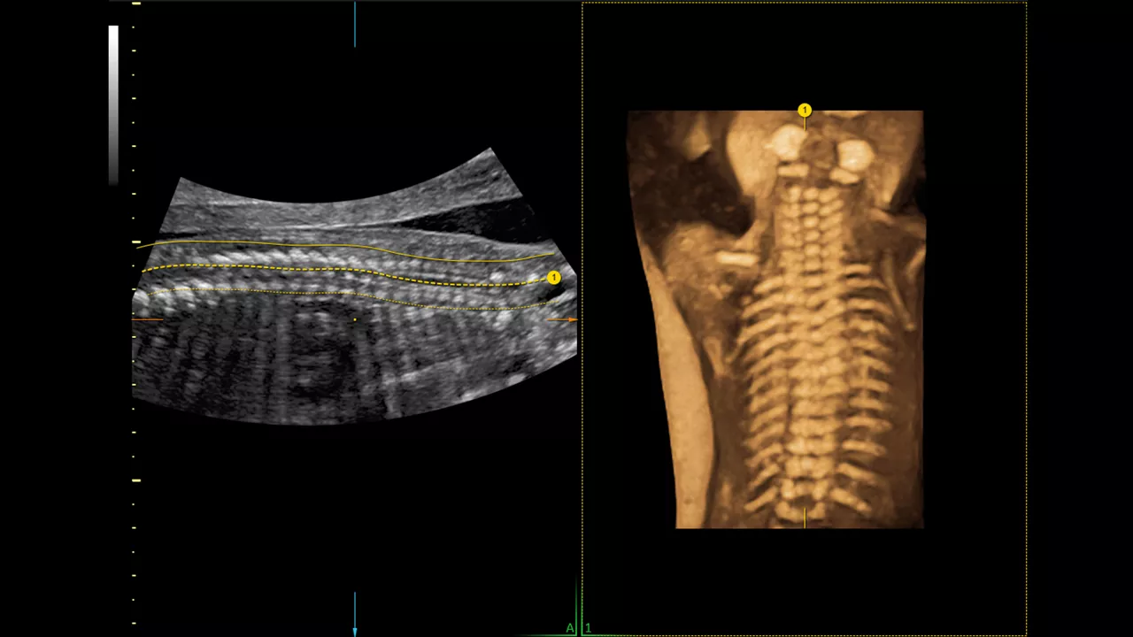 6-spine-trace