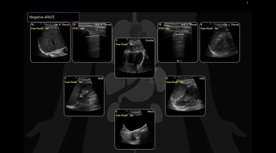eFAST exam diagram on the Venue ultrasound system