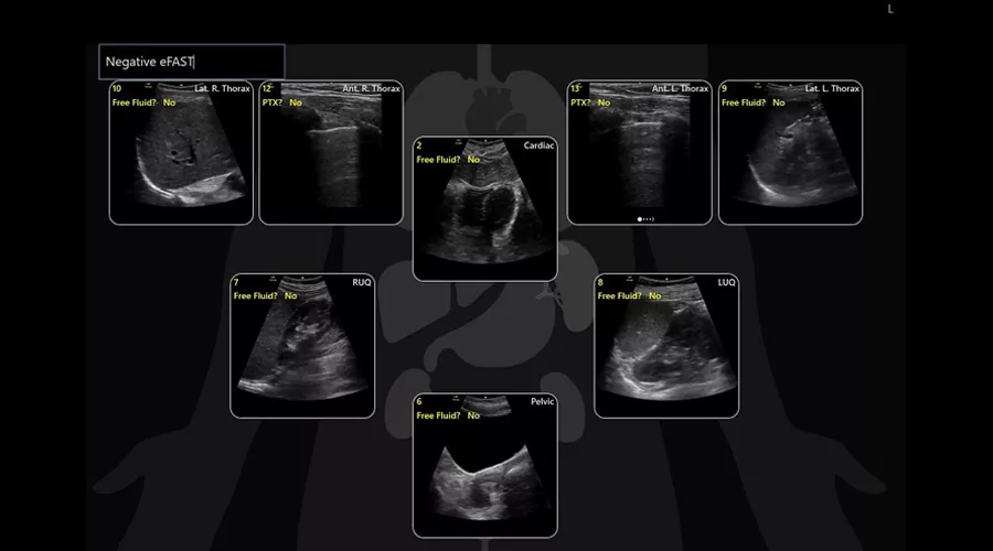 eFAST exam diagram on the Venue ultrasound system