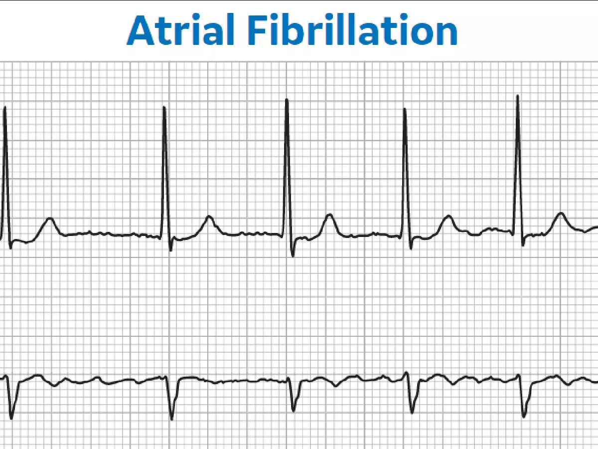 AFib