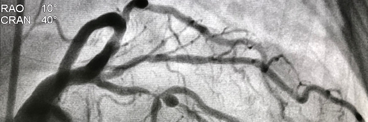 Coronary_Angiogram