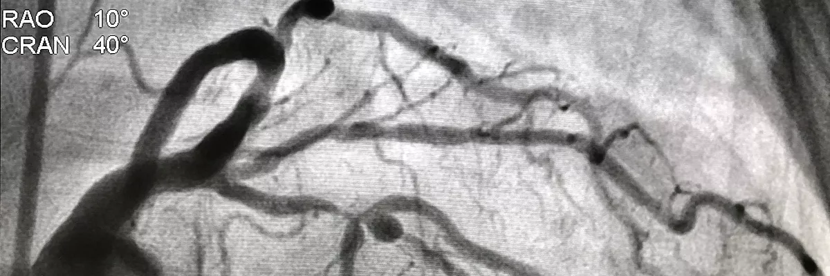 Coronary_Angiogram