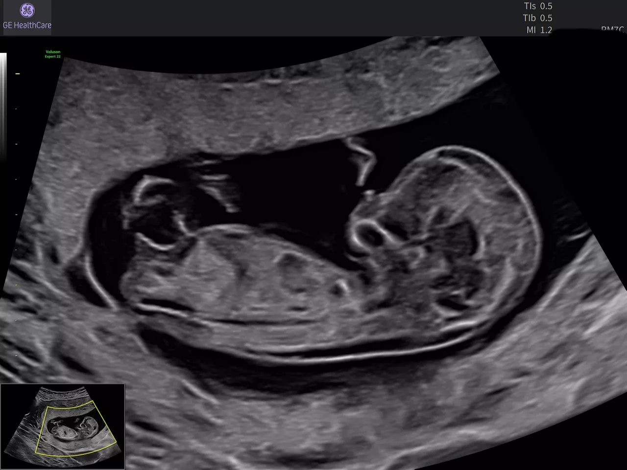 EXP22-RM7C-OB-2D-SAG-FETUS-W-AND-WO-SONOBIO-12W4D-2-scurve-image