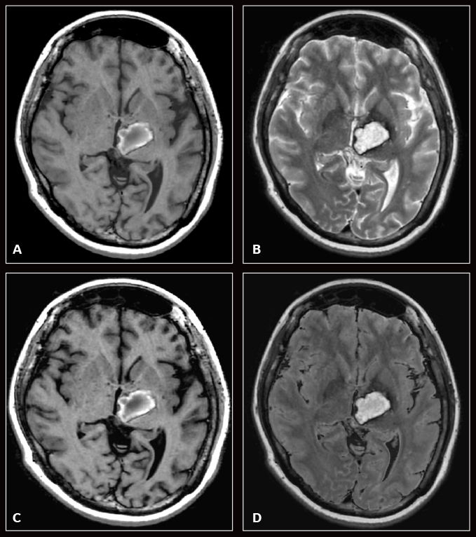MR Imaging post COVID