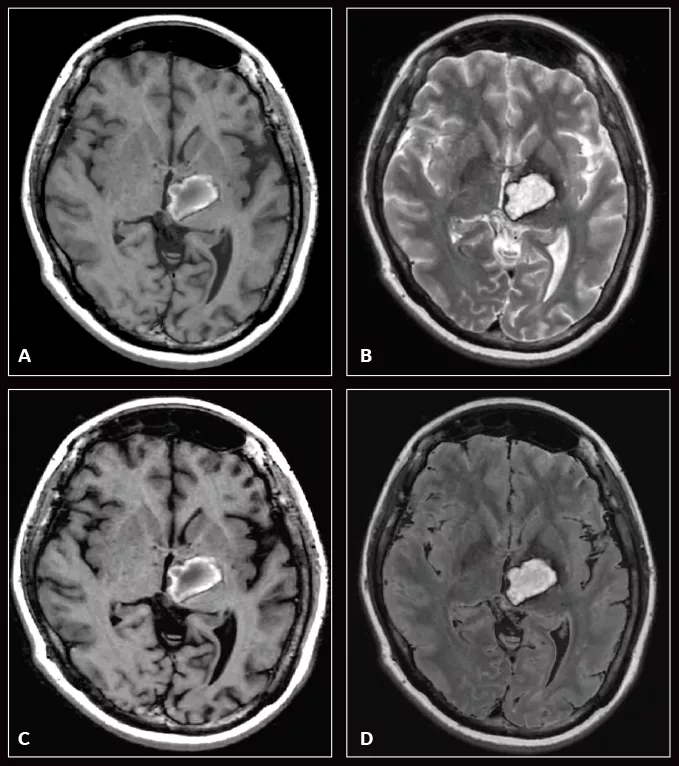 MR Imaging post COVID