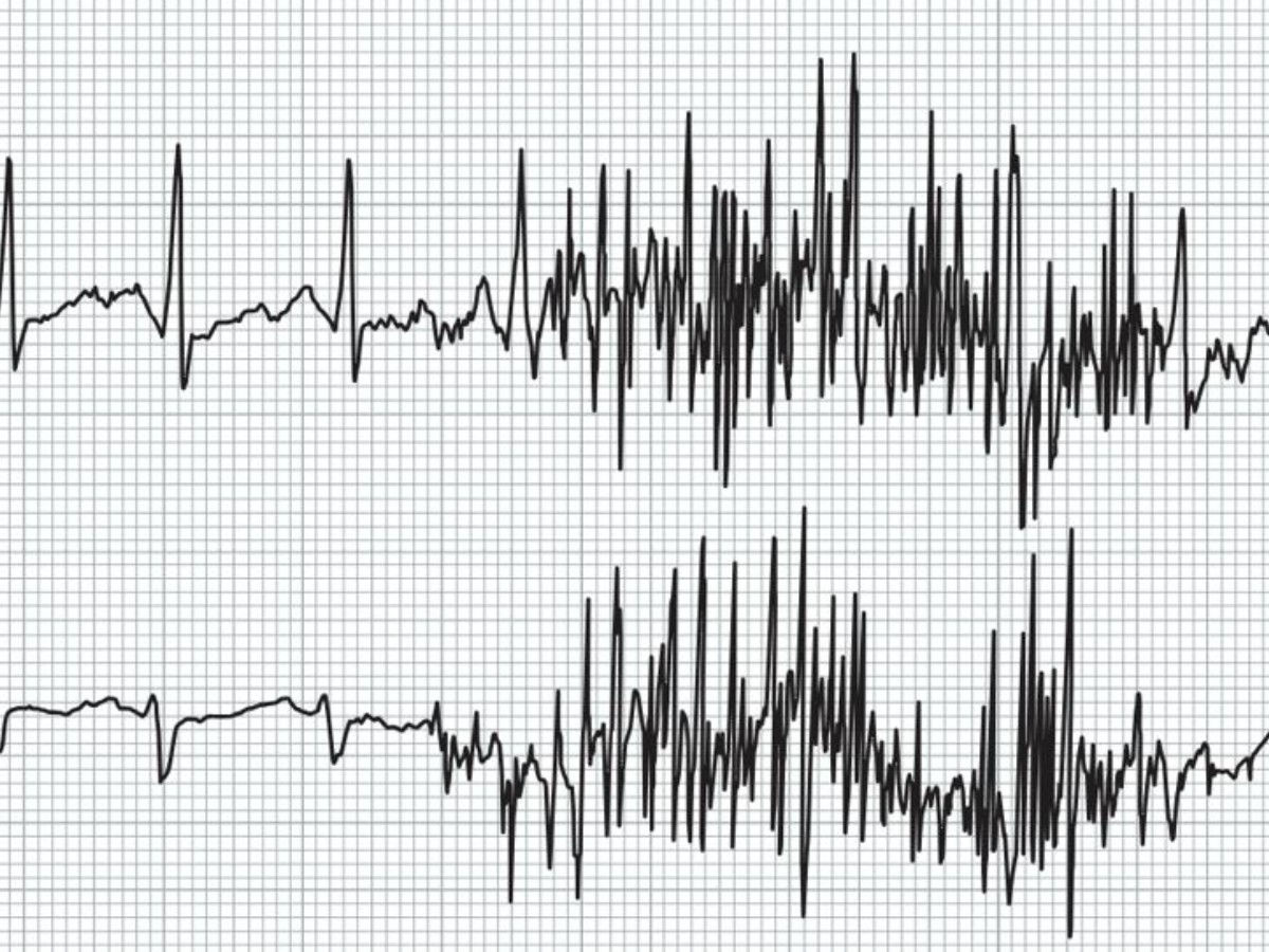 Muscle_Tremor