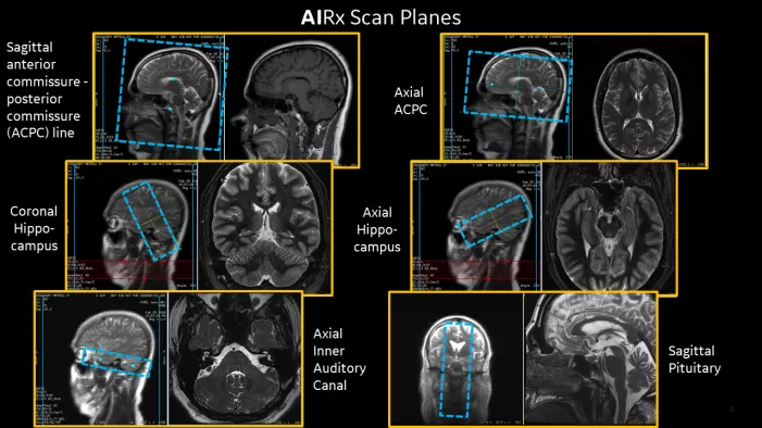 No_matter_how_you_slice_it_this_AI_tech_is_changing_MR_neuro_imaging