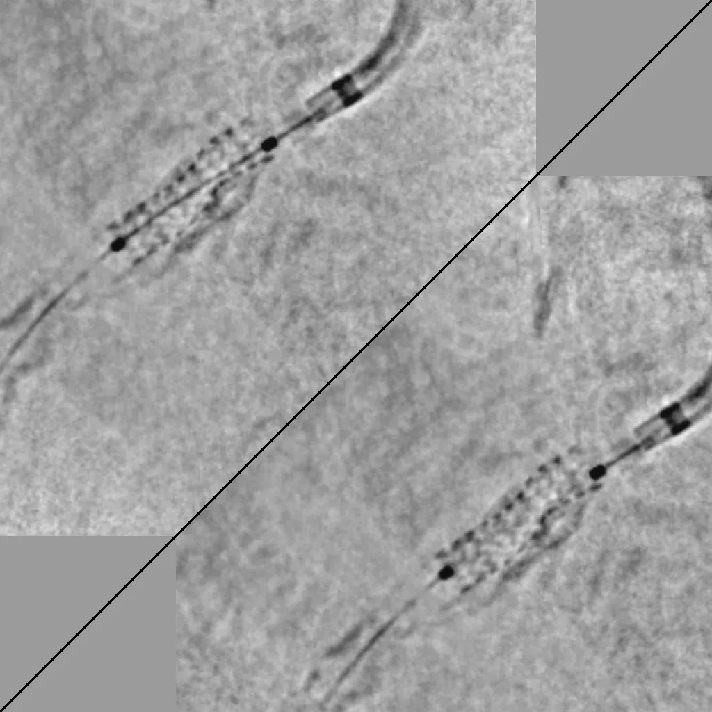 SV_Calcified