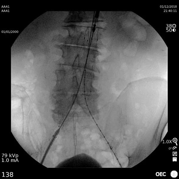 AAA_Calibration Catheter Placement