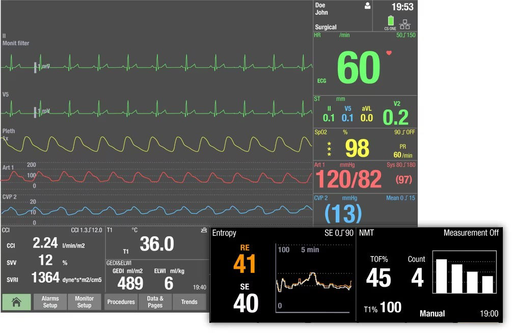 adequacy-of-anesthesia-holistic-view-scurve-ci-en