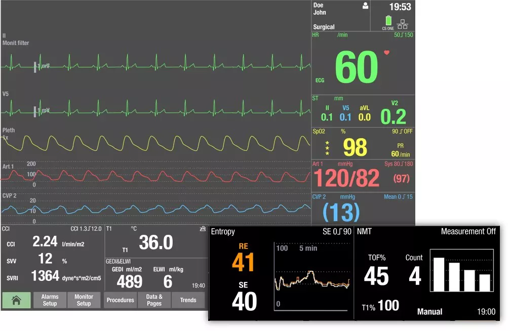 adequacy-of-anesthesia-holistic-view-scurve-ci-en