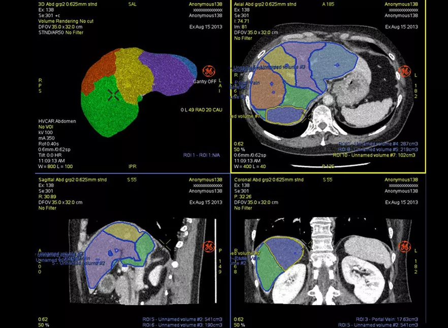 advanced-visualization-applications-hepatic-vcar-image-gallery-aw-hepatic-vcar-rev138i_jpg