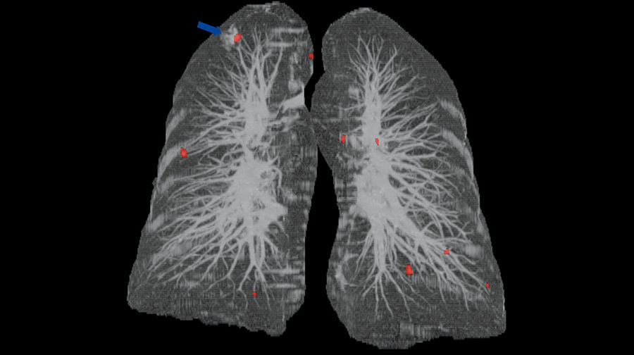 advanced-visualization-applications-lung-vcar-image-gallery-aw-lung-vcar-clinical2