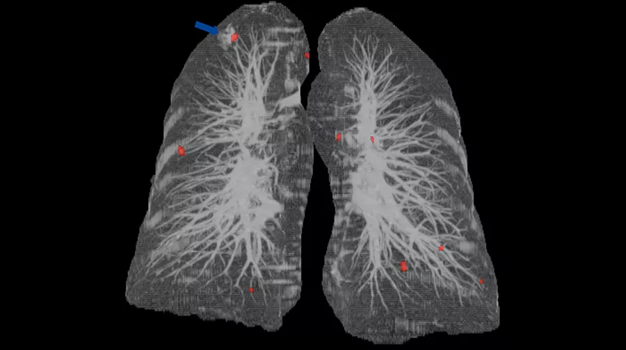 advanced-visualization-applications-lung-vcar-image-gallery-aw-lung-vcar-clinical2