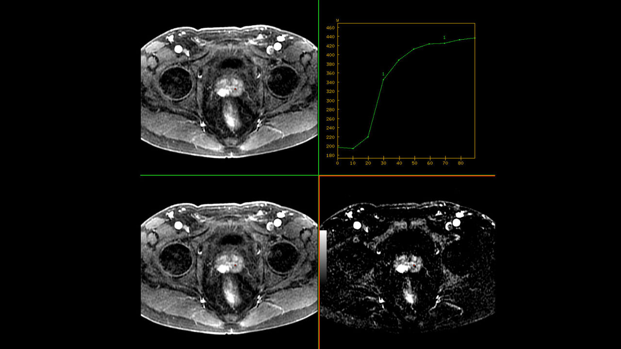 advanced-visualization-applications-readyview-aw-readyview-clinical-image-subtraction