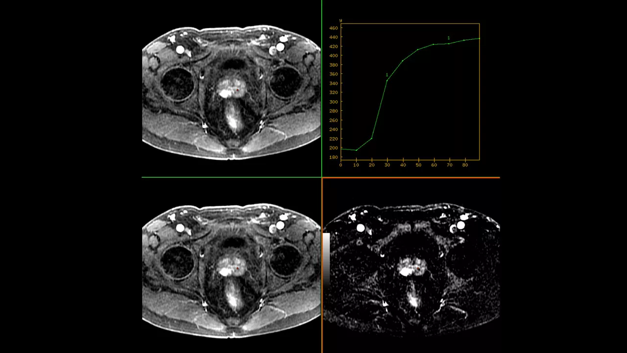 advanced-visualization-applications-readyview-aw-readyview-clinical-image-subtraction