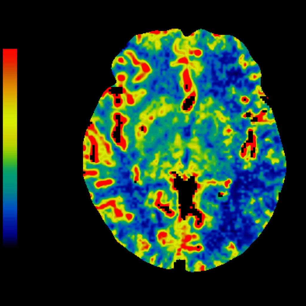 -advanced-visualization-applications-ct-perfusion-4d-neuro-aw-ct-perfusion-4d-overview.jpg