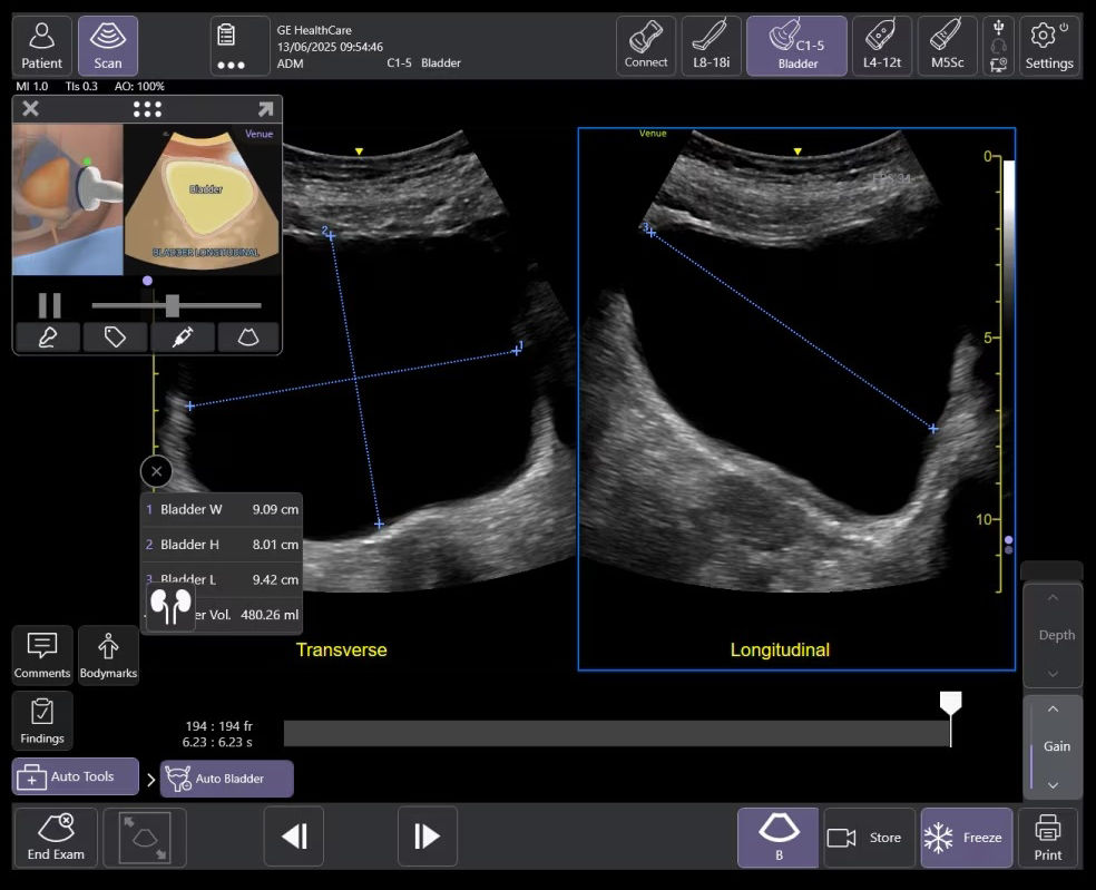 ai-enabled-auto-bladder-volume-ci-en