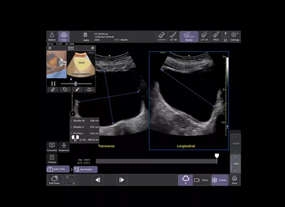 ai-enabled-auto-bladder-volume-ci-new