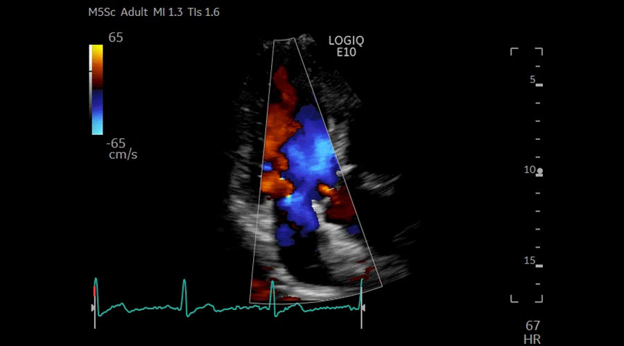 ALAX-CF-MITRAL-AND-AORTIC-VALVES-M5Sc-D_900x500
