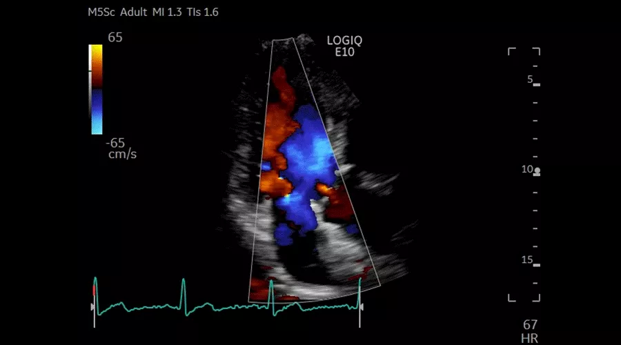 ALAX-CF-MITRAL-AND-AORTIC-VALVES-M5Sc-D_900x500