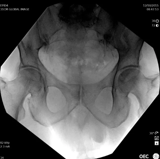 AP Hip_Diamond View