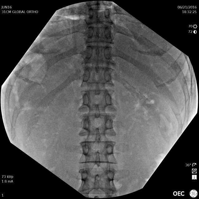 AP Lower Thoracic_Upper Lumbar
