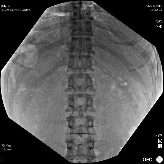 AP Lower Thoracic_Upper Lumbar