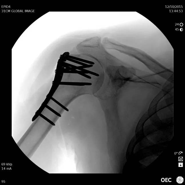AP Shoulder