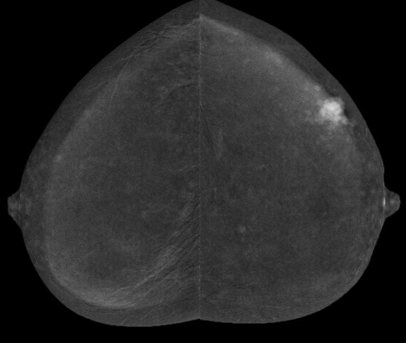 aphy-mammography-new-seno-bright-hd-thumbnails-senobright-hd_breast-imaging-thumbnail1.jpg