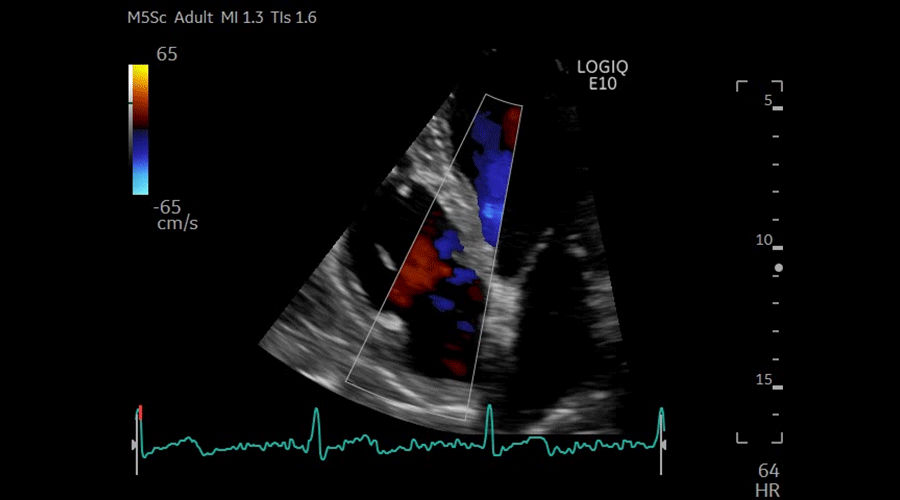 APICAL-4CH-CF--TRICUSPID-VALVE-M5Sc-D_900x500