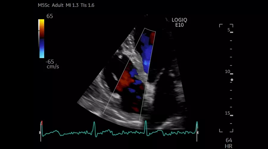 APICAL-4CH-CF--TRICUSPID-VALVE-M5Sc-D_900x500